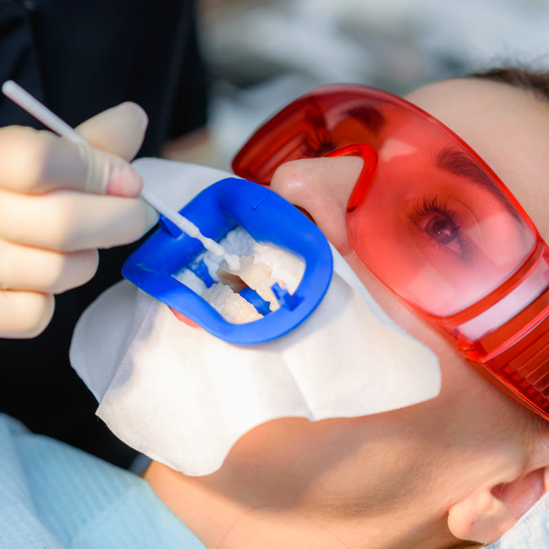 Moça deitada em uma cadeira odontológica, com aparato abrindo sua boca, para aplicação de clareamento dental, com óculos de segurança e com o dentista aplicando produto no dentes, com um pincel fino.