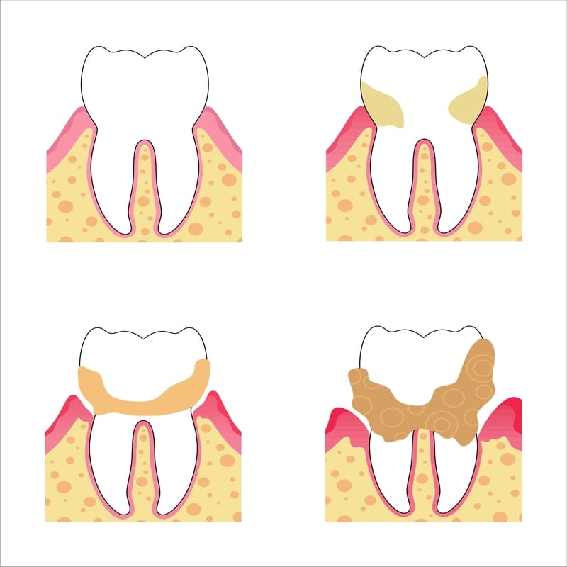 Uma ilustração com quatro dentes, sendo o primeiro saldável e os outros três com níveis progressivos de contaminação com placas de tártaro.