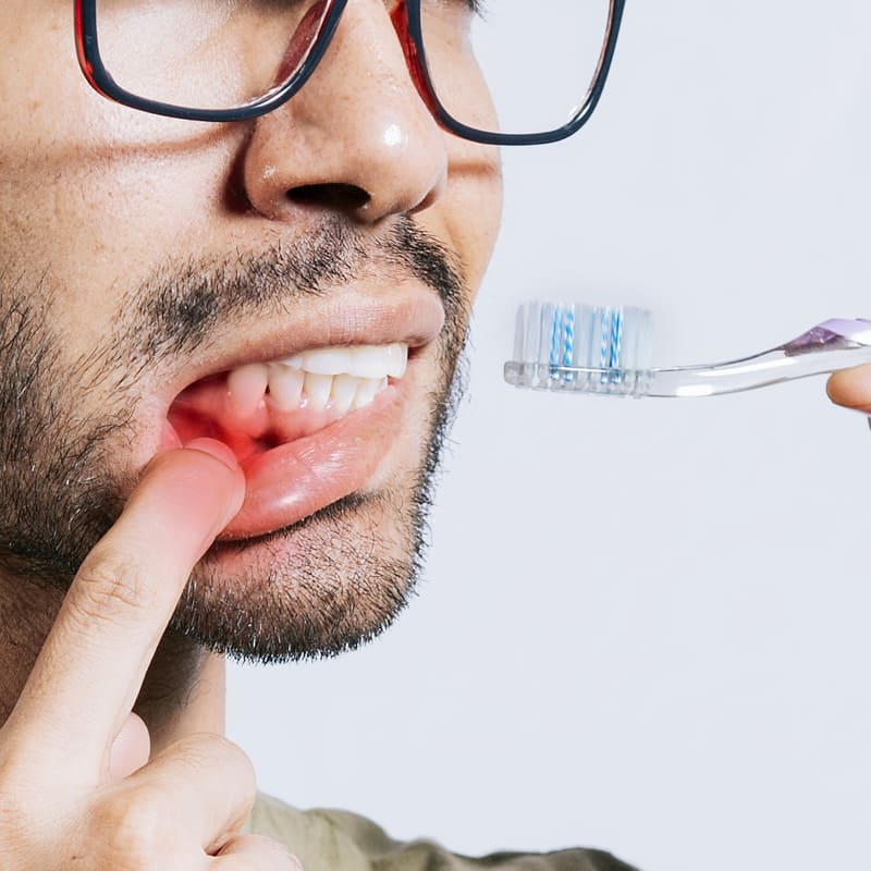 Homem segurando a escova de dentes perto da boca, e com um dedo da outra mão, puxa o lábio inferior para baixo, mostrando sua gengiva com sangue.