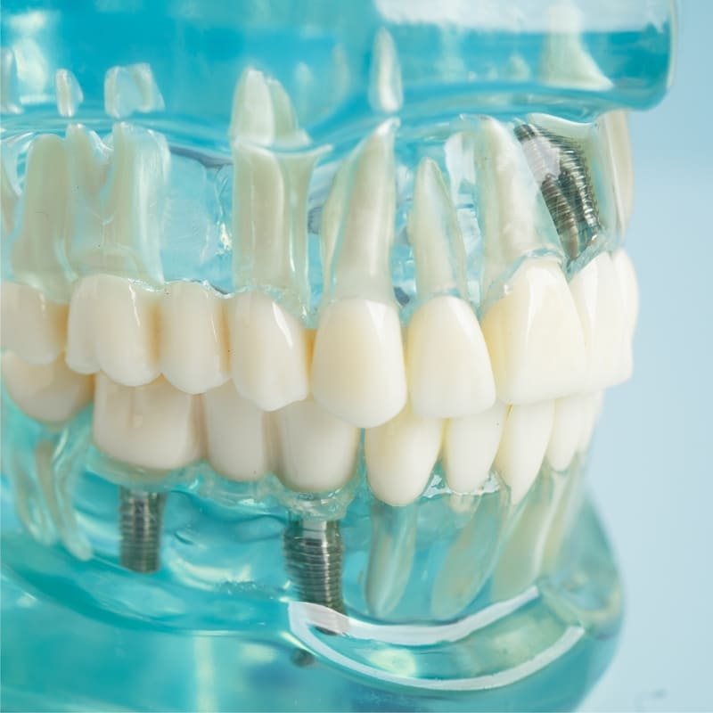 Uma arcada dentária feita em acrílico transparente, mostrando os parafusos que compõe os três implantes dentários nela contida.
