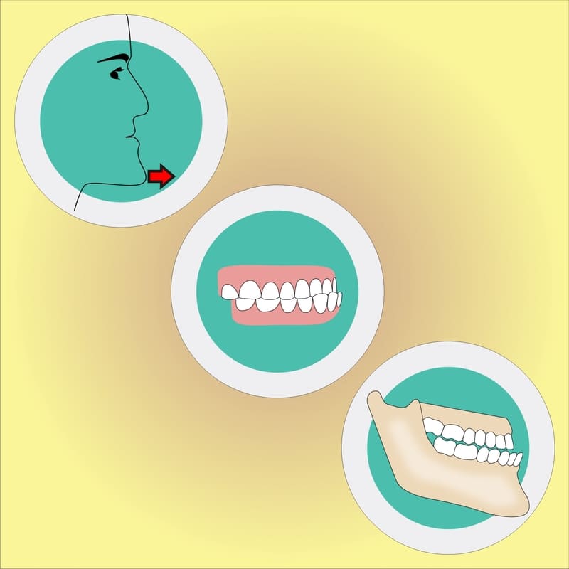Desenho de uma pessoa com o distúrbio odontológico de mandíbula prognata, onde o queixo fica para frente.
